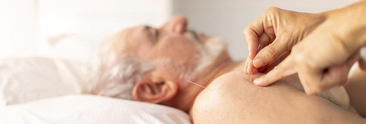 Acupuncture for Stress Relief